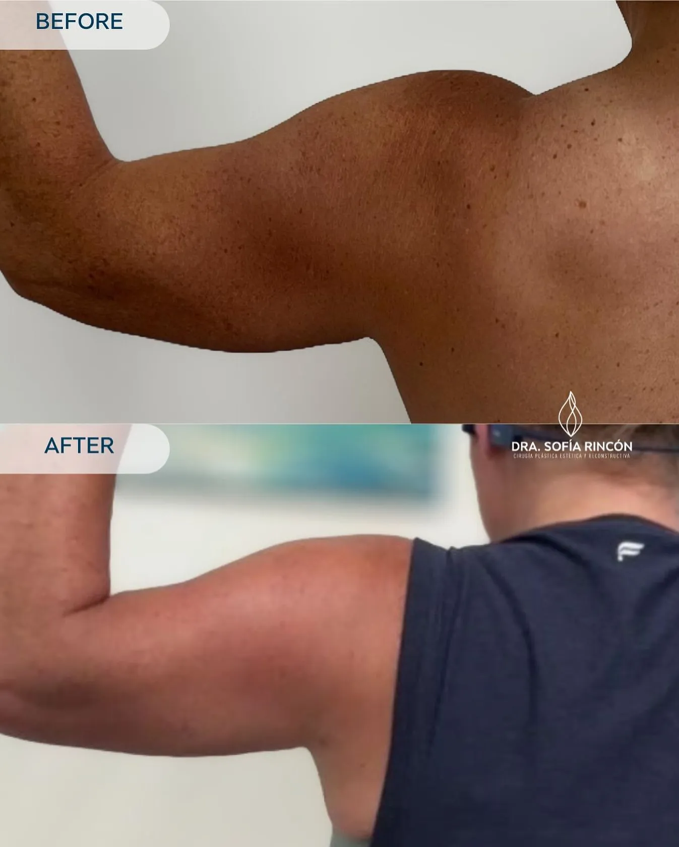 Arm lipo before and after result 1