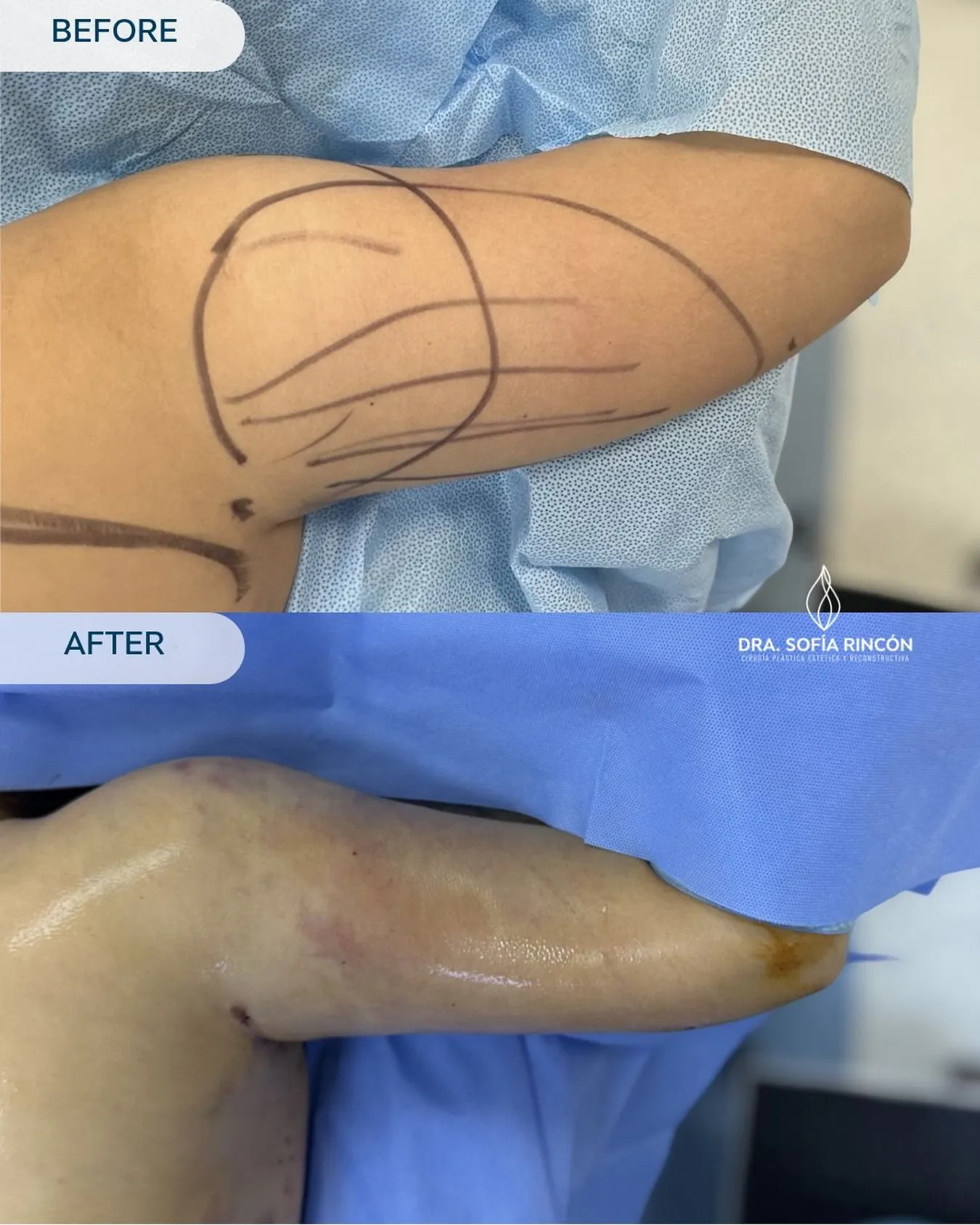 Arm lipo before and after result 10