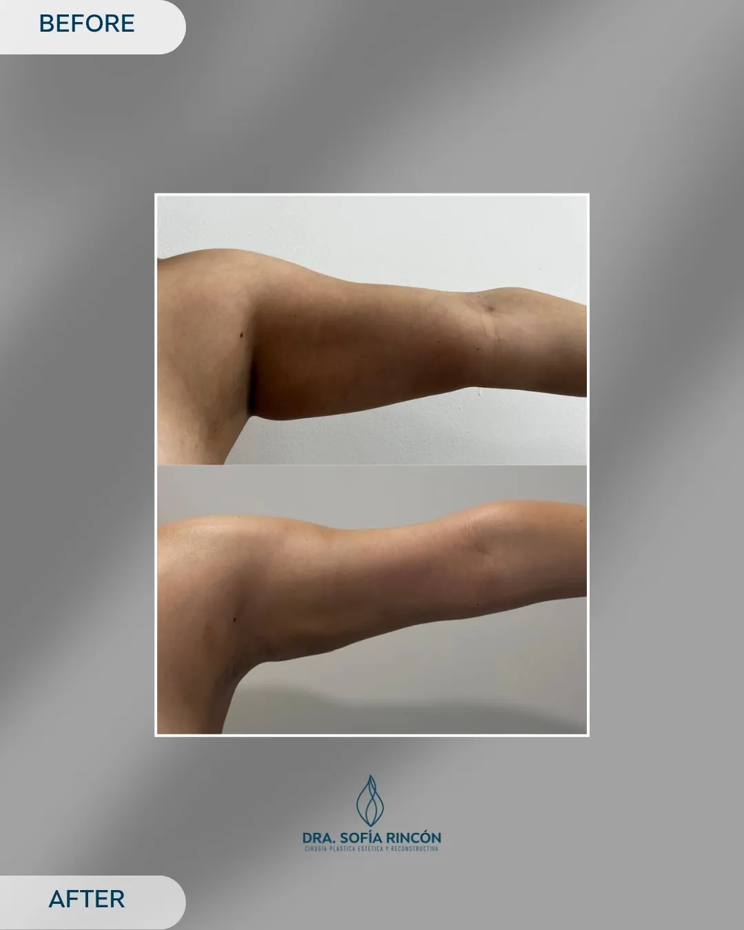 Arm lipo before and after result 11