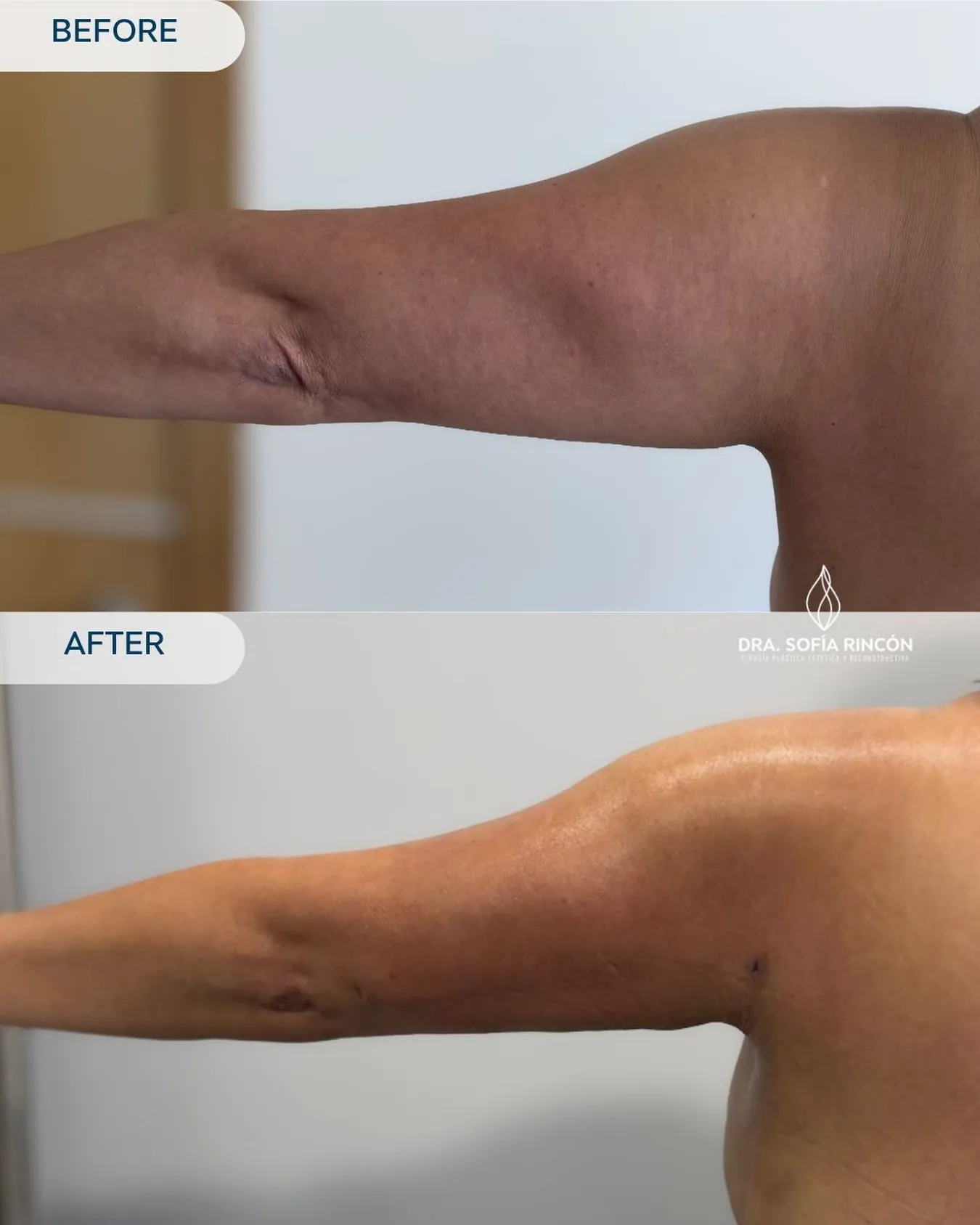 Arm lipo before and after result 12