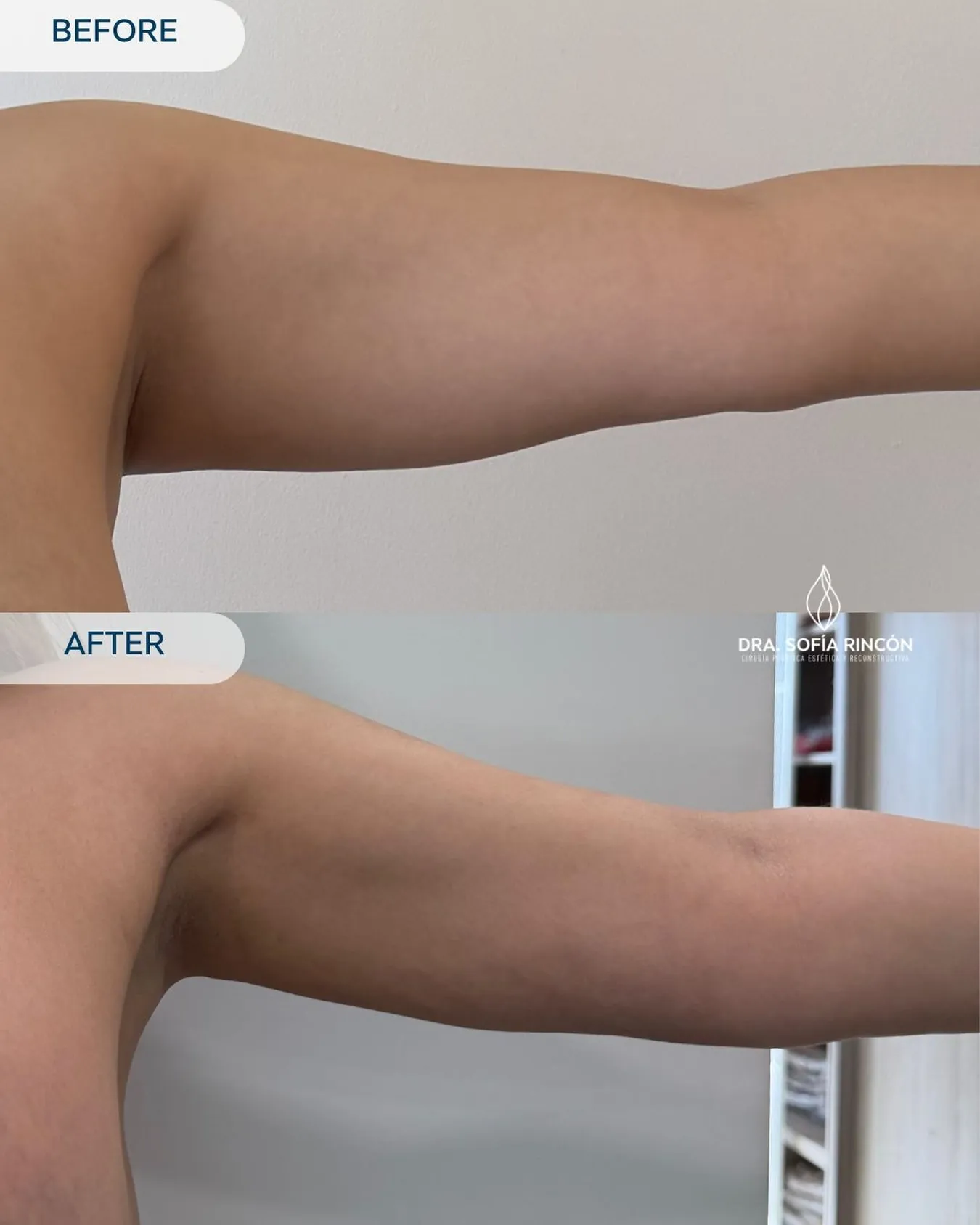 Arm lipo before and after result 13
