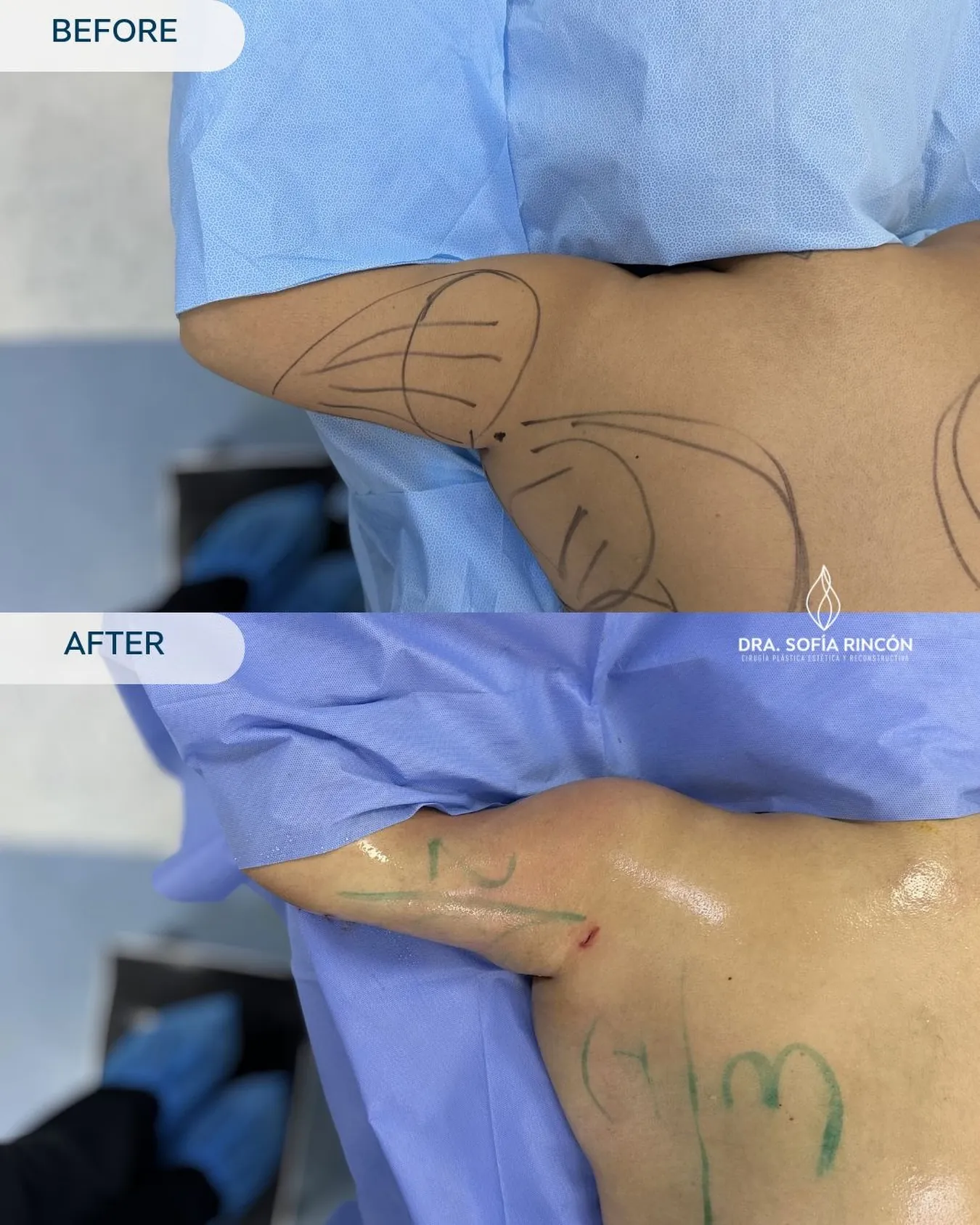 Arm lipo before and after result 14