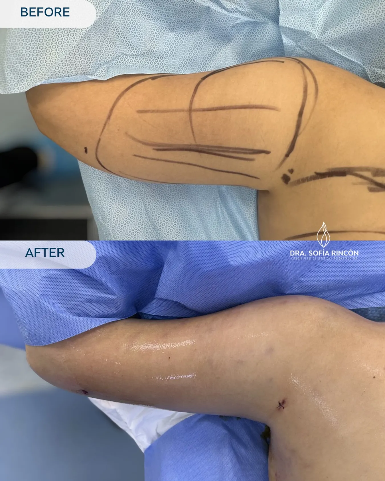 Arm lipo before and after result 15