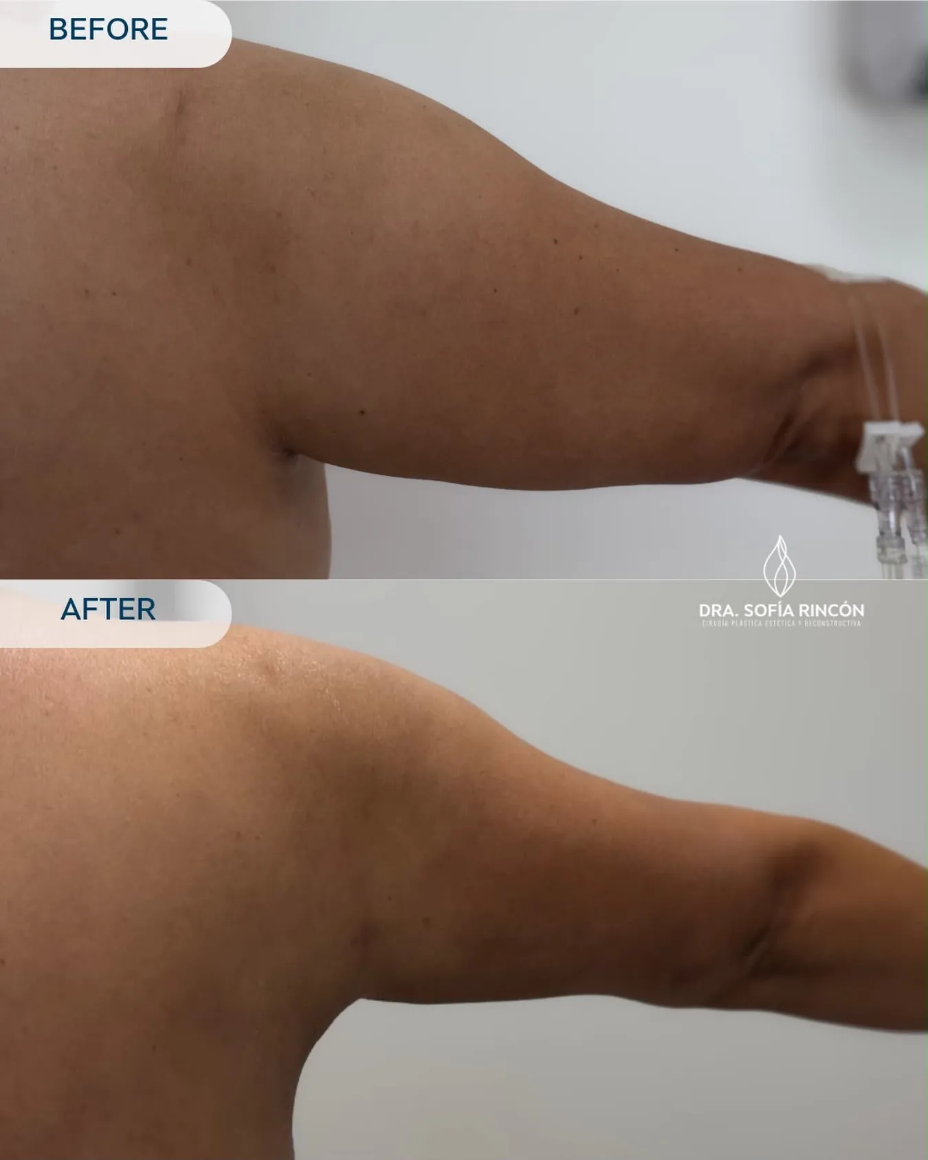 Arm lipo before and after result 16