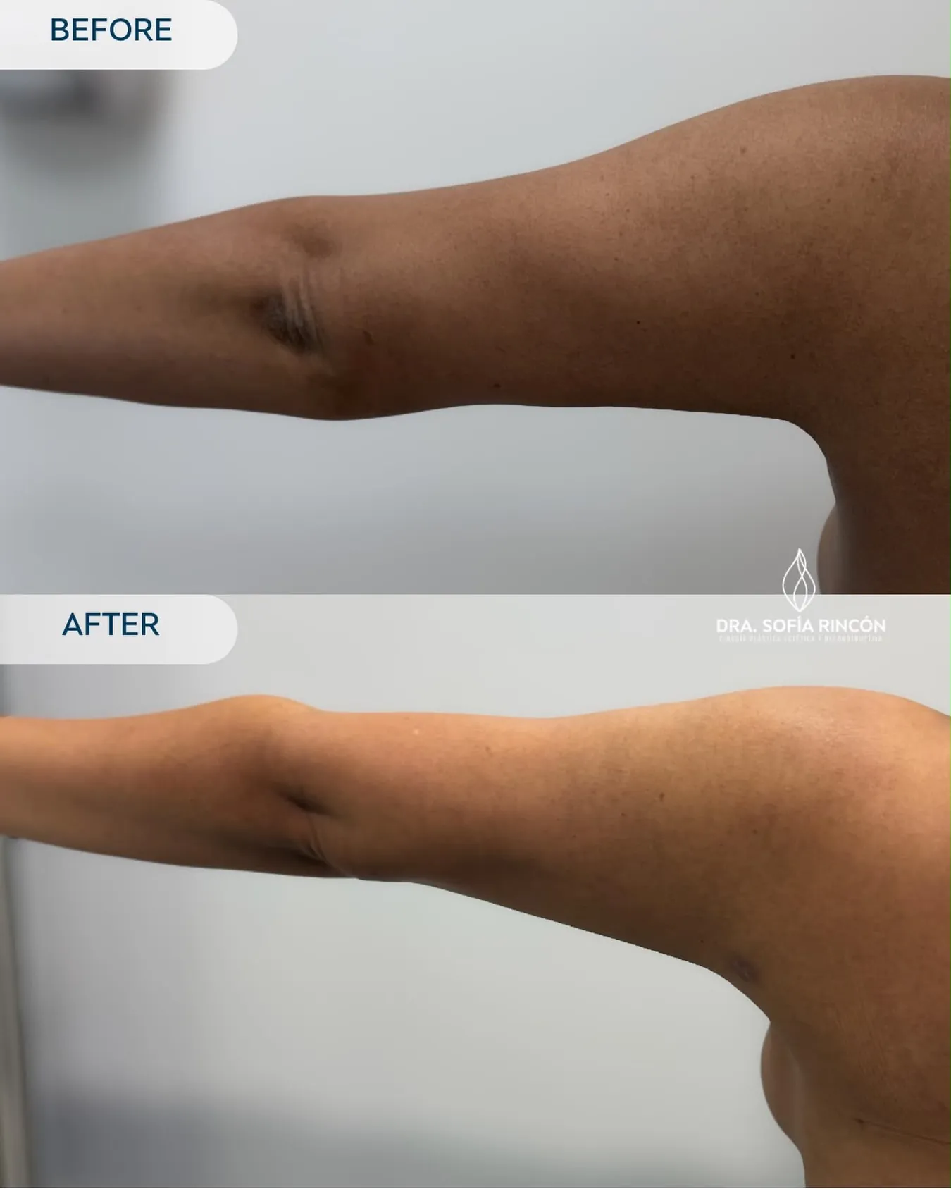 Arm lipo before and after result 17
