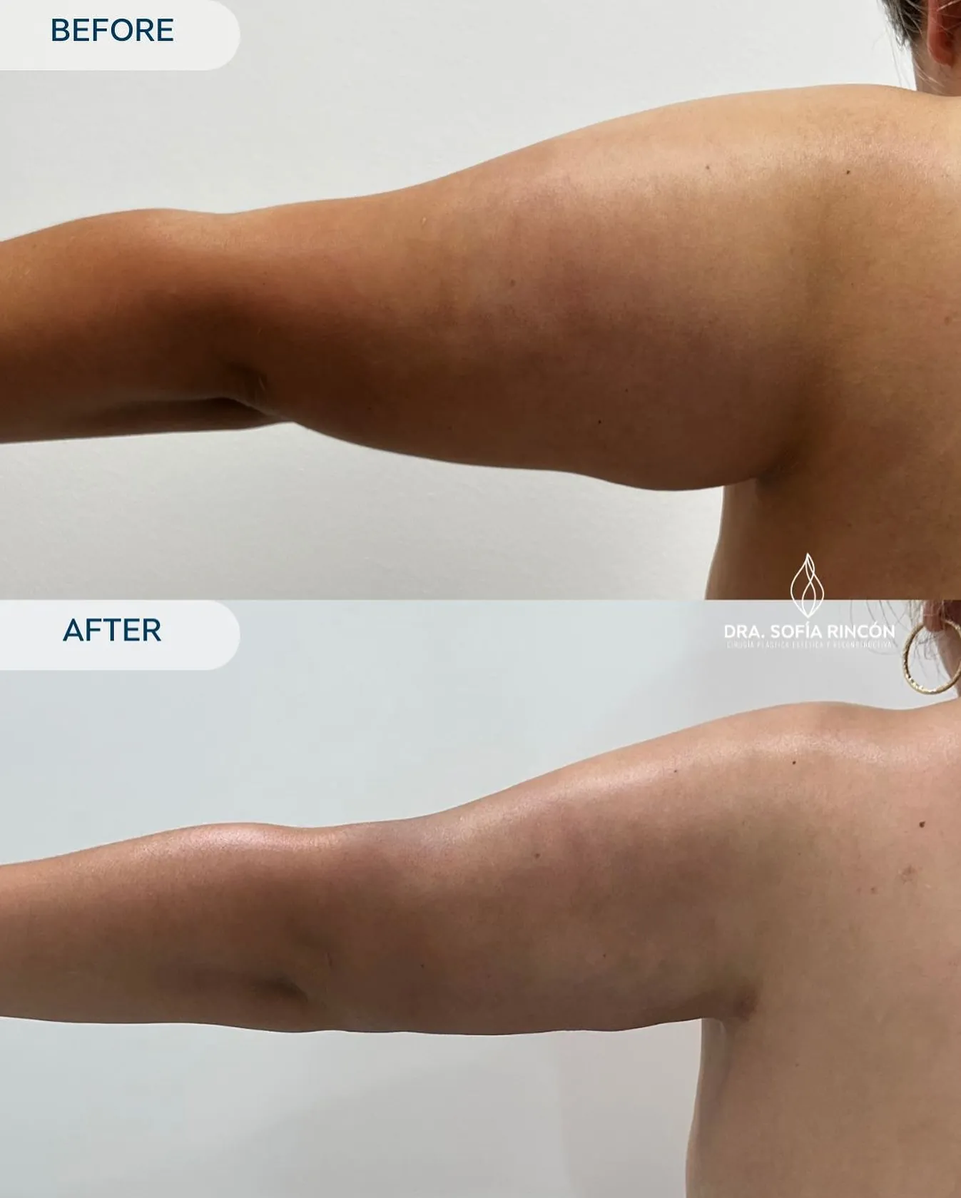Arm lipo before and after result 2
