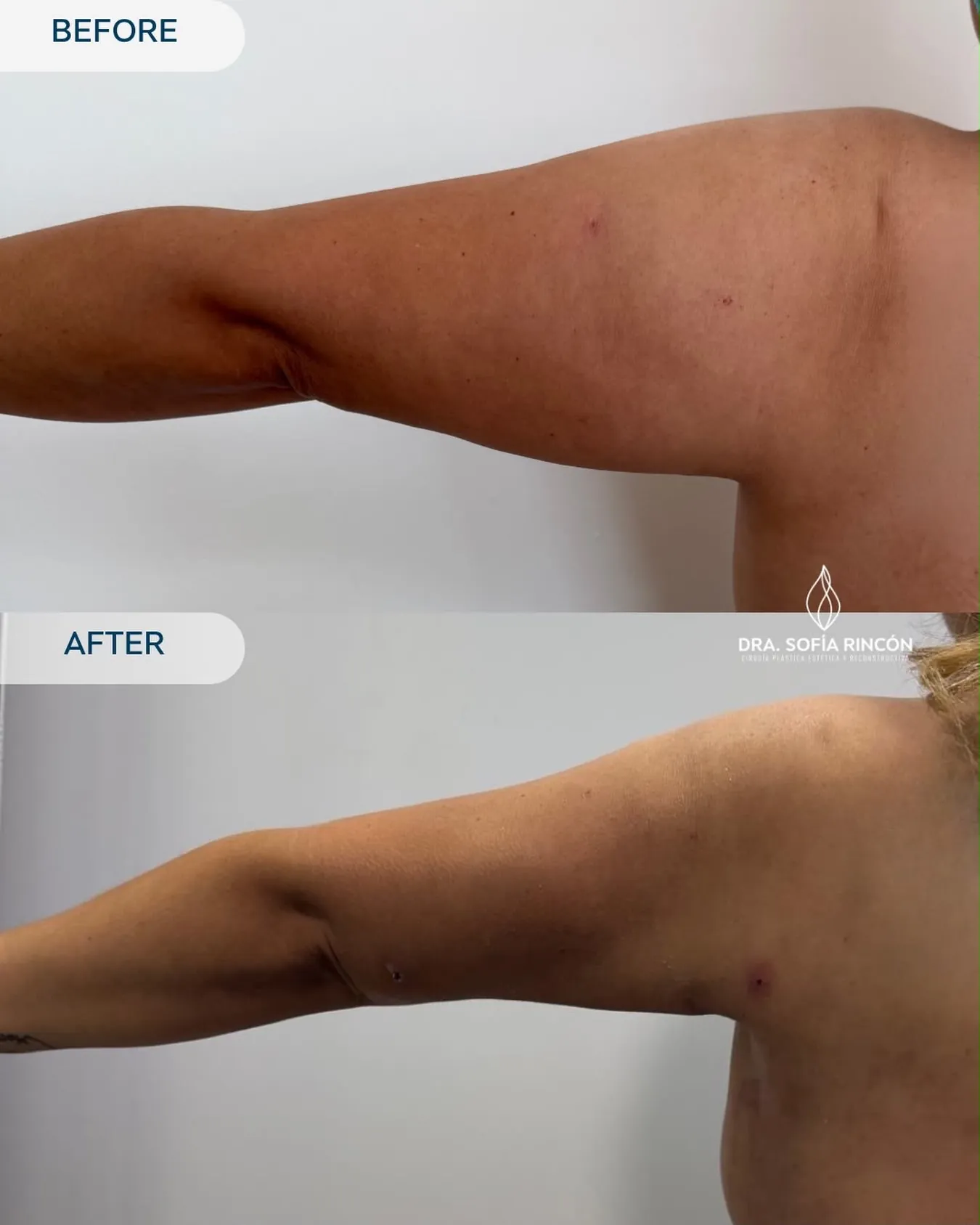 Arm lipo before and after result 18