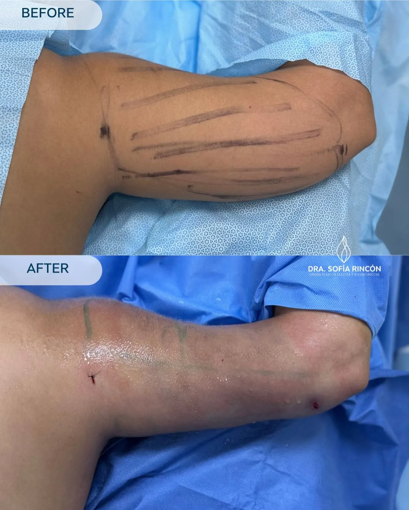 Arm lipo before and after result 3