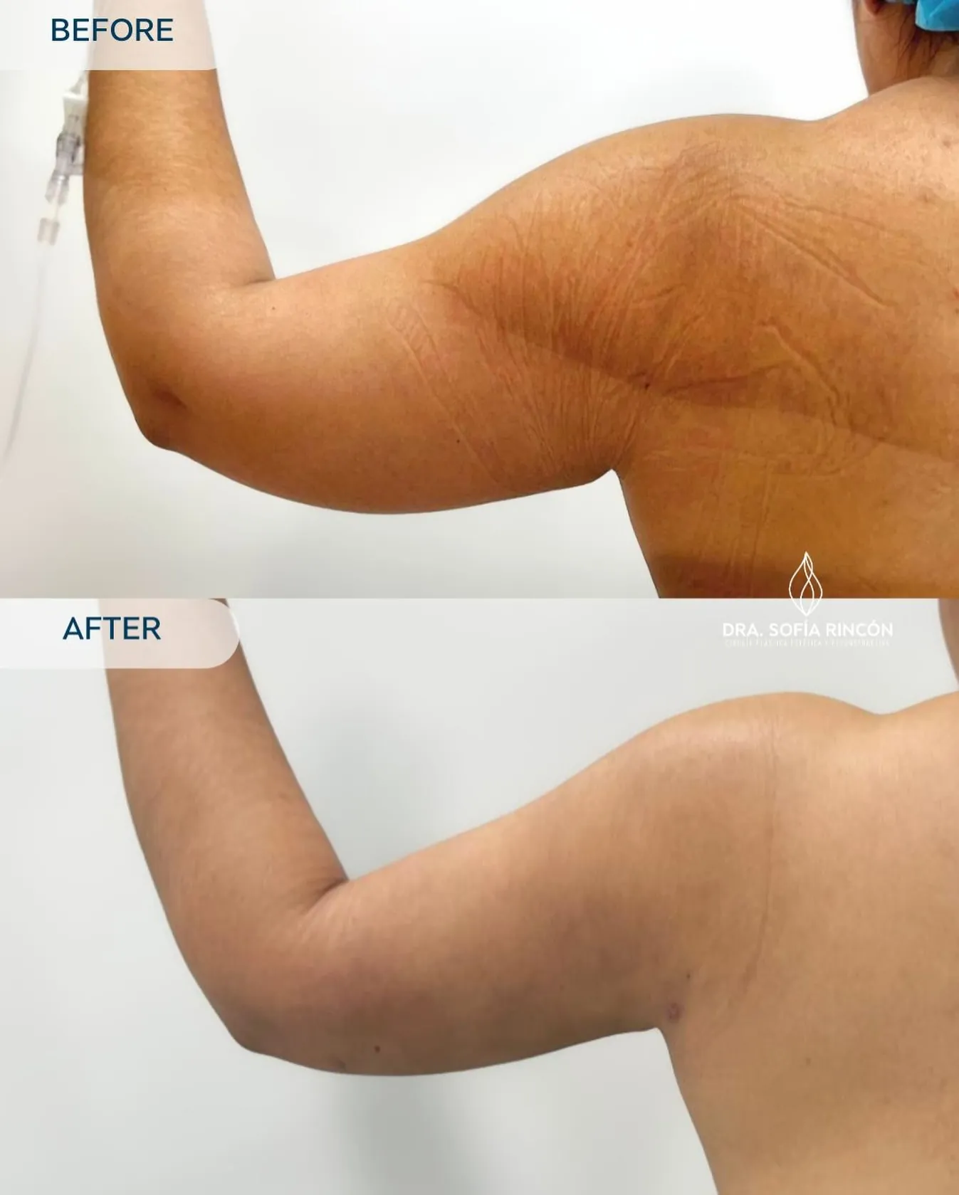 Arm lipo before and after result 4
