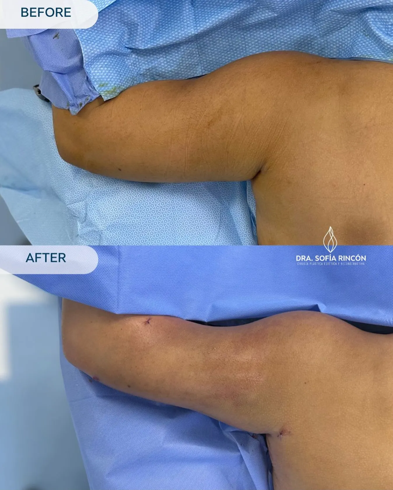 Arm lipo before and after result 5