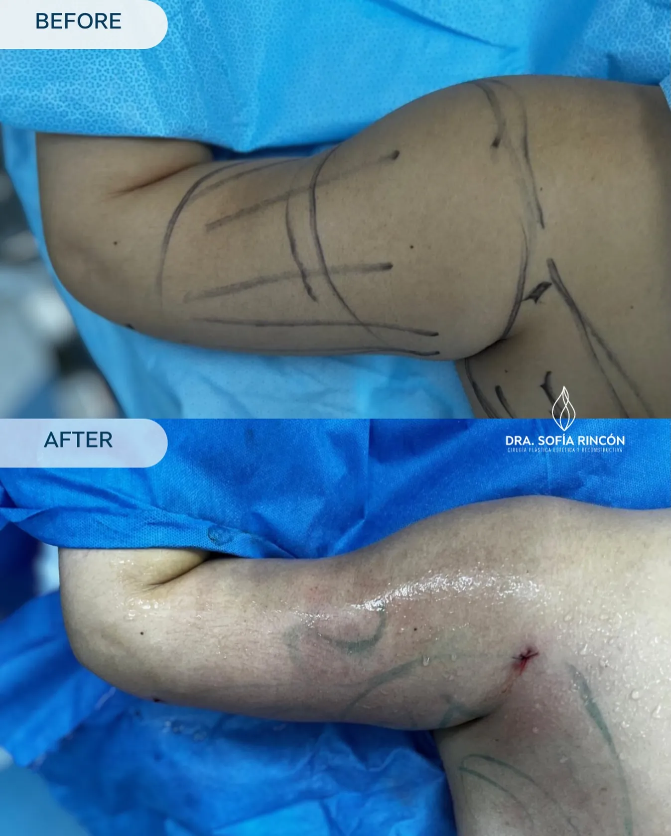 Arm lipo before and after result 6