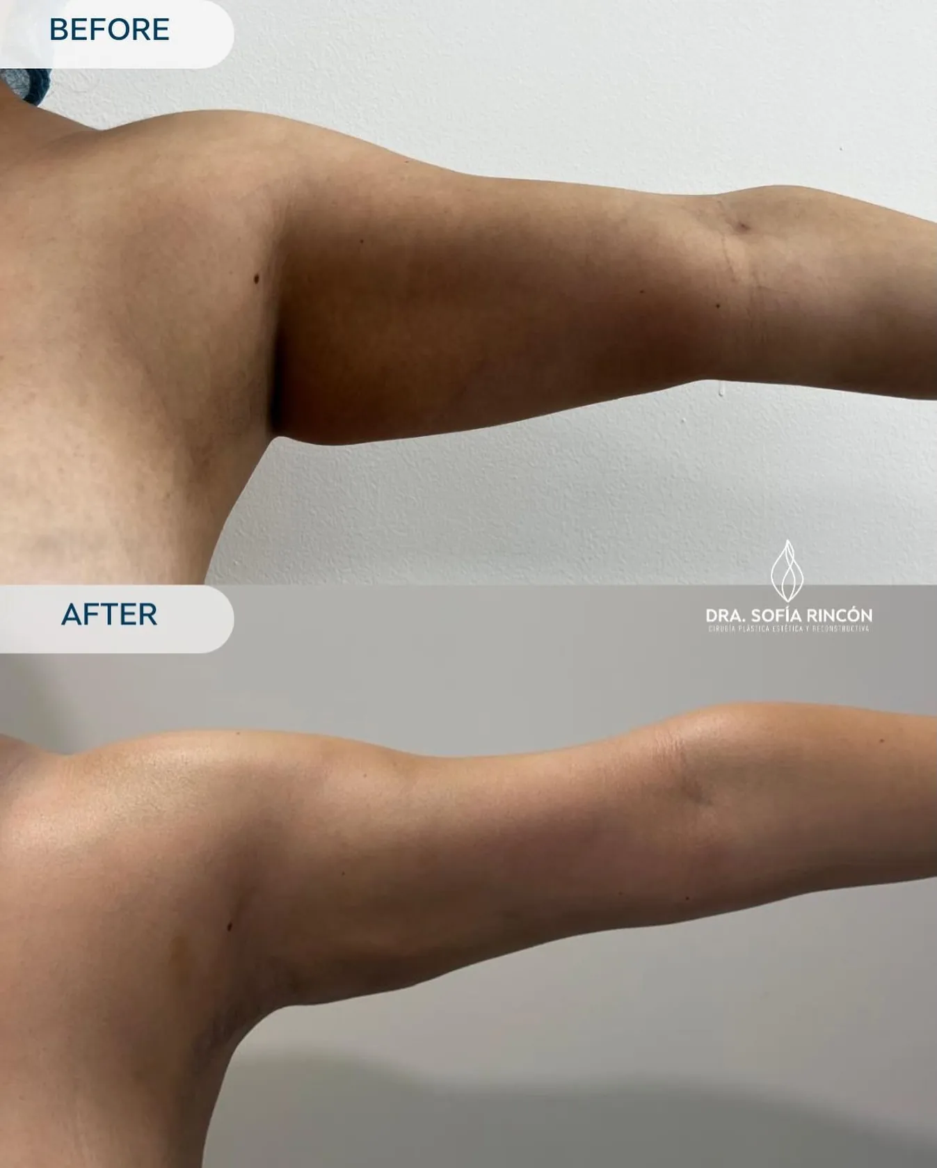 Arm lipo before and after result 7