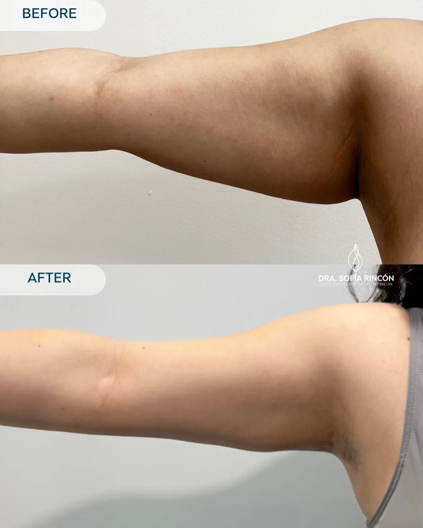 Arm lipo before and after result 8