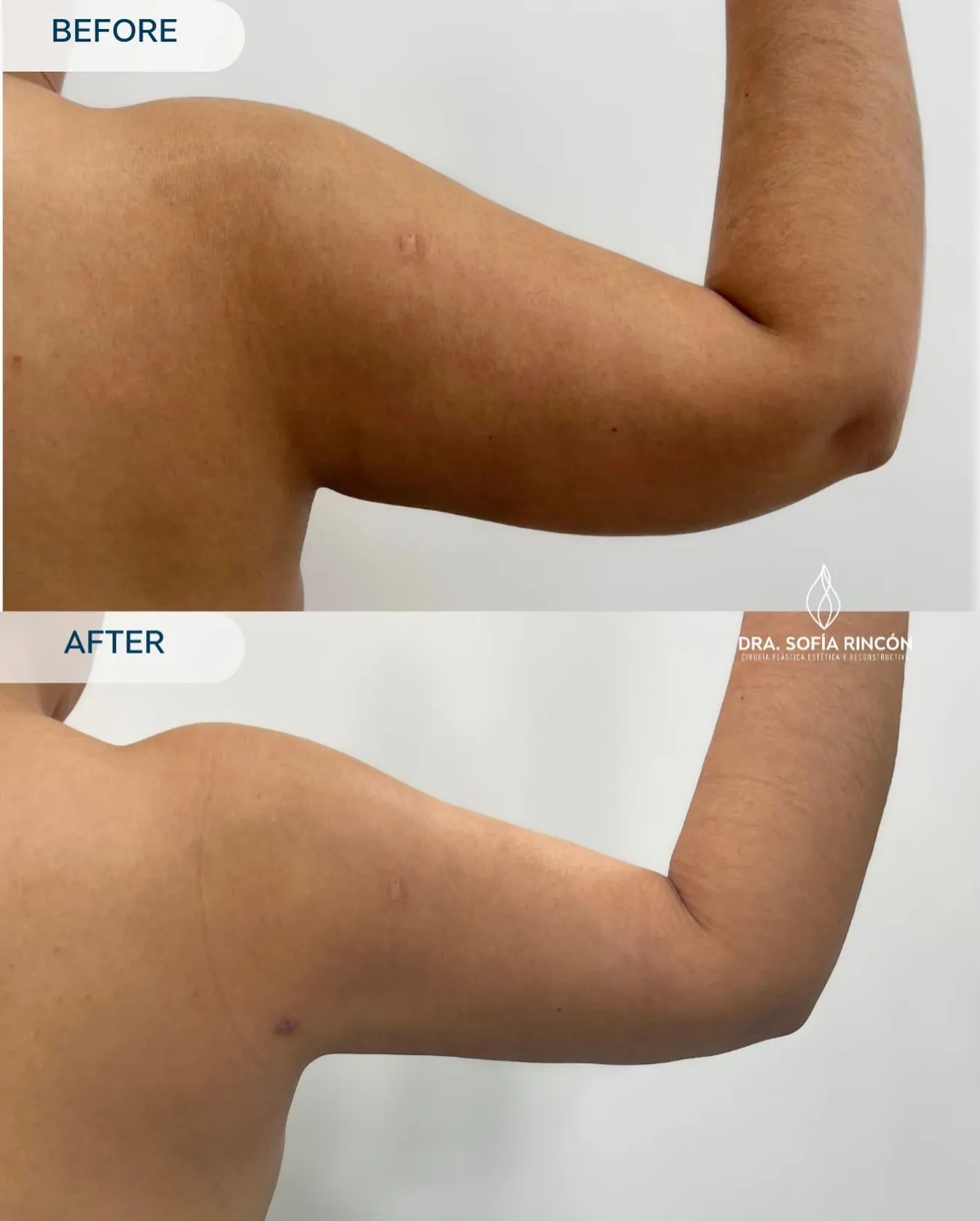 Arm lipo before and after result 9