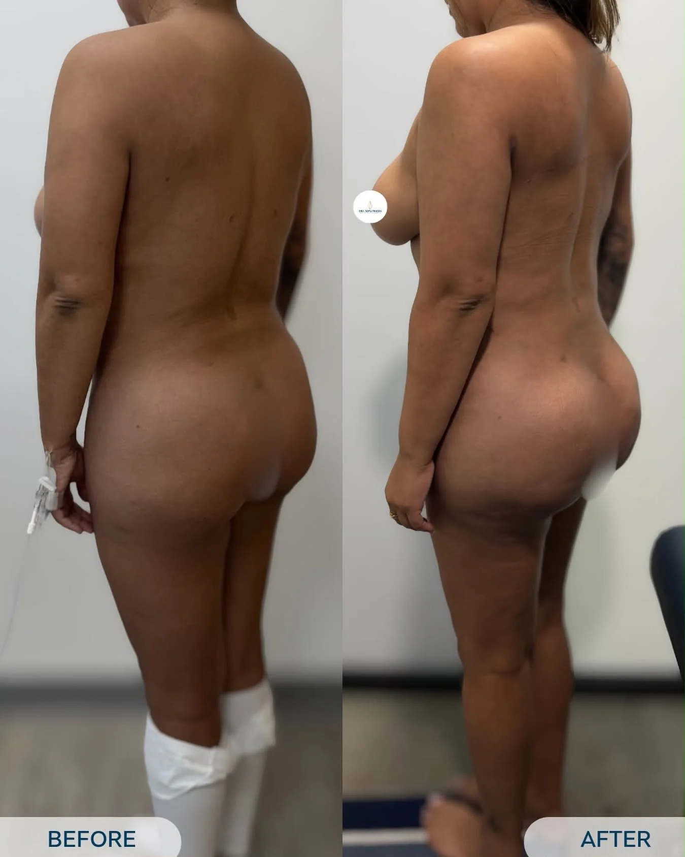 BBL before and after result 1