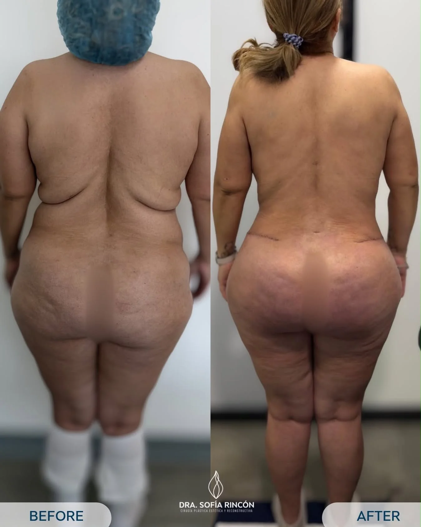 BBL before and after result 5