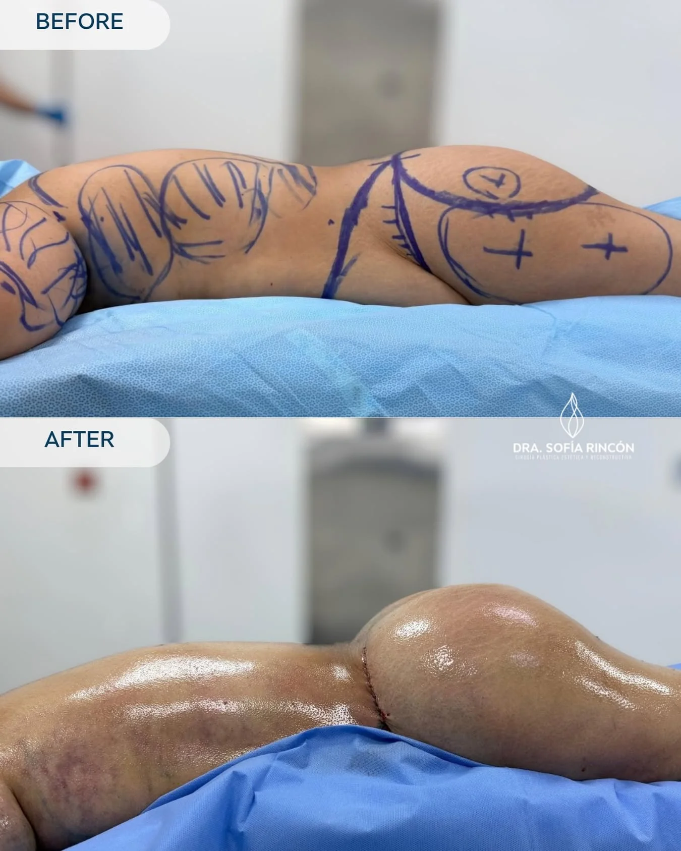 BBL before and after result 8