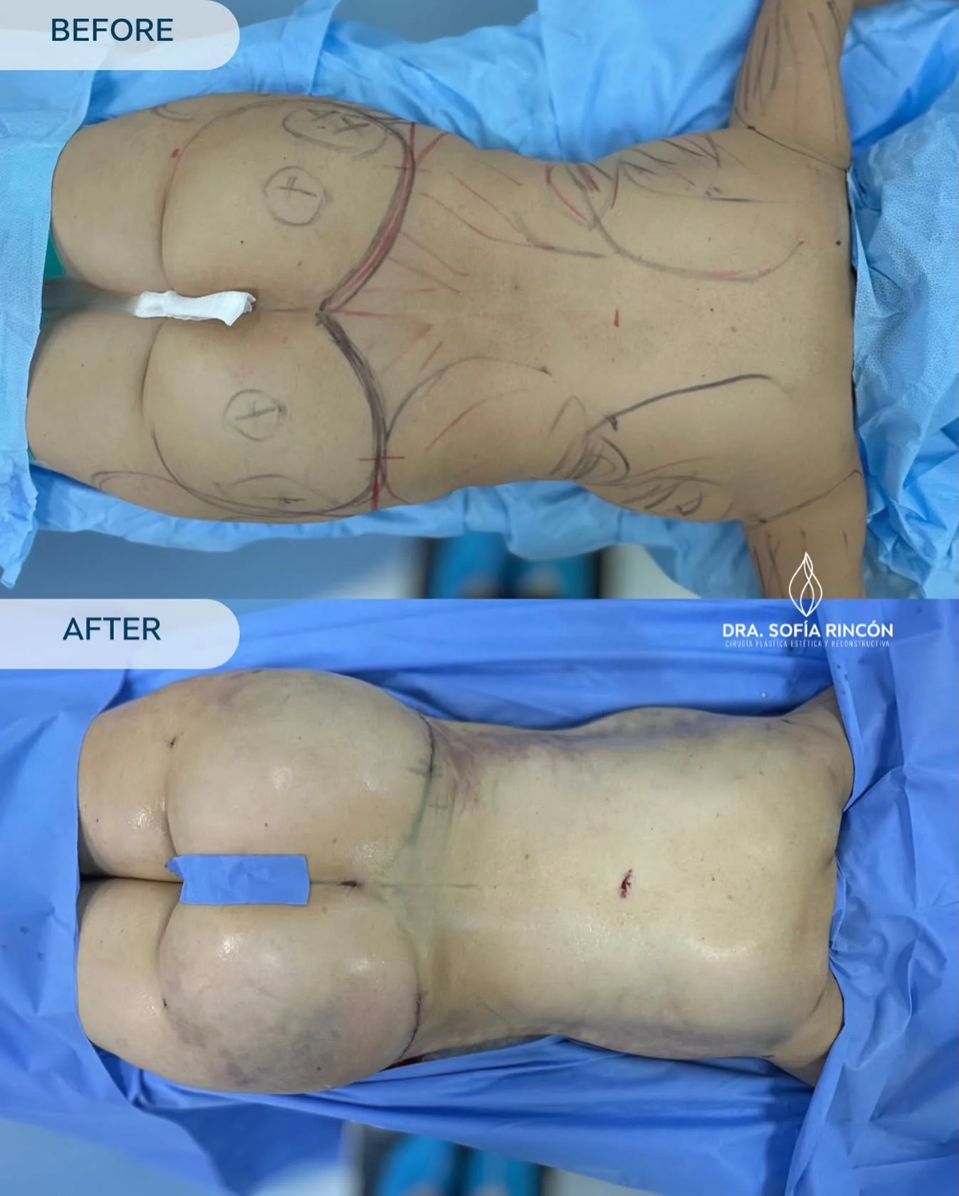 BBL before and after result 9
