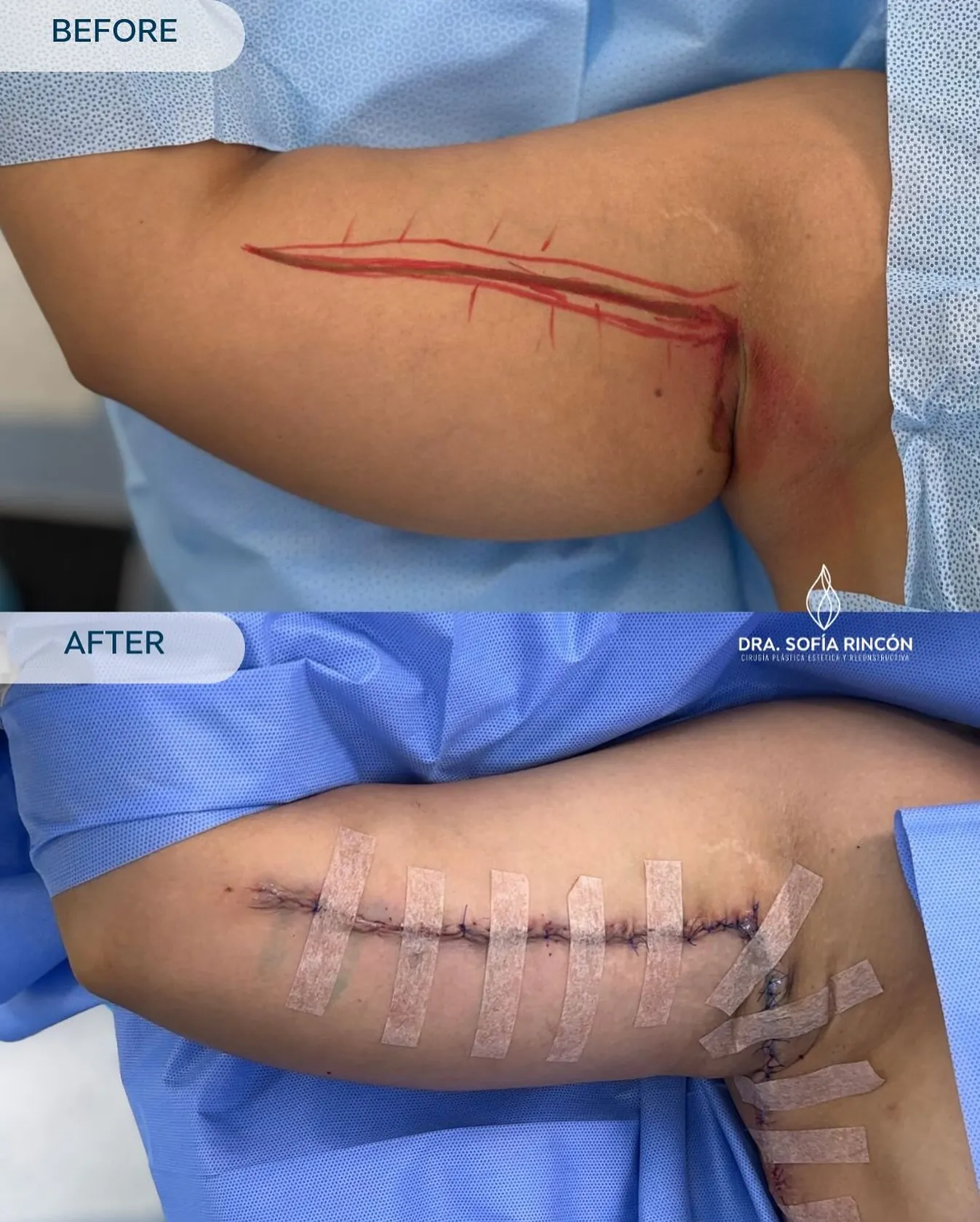 Resultado de braquioplastia antes y después 1