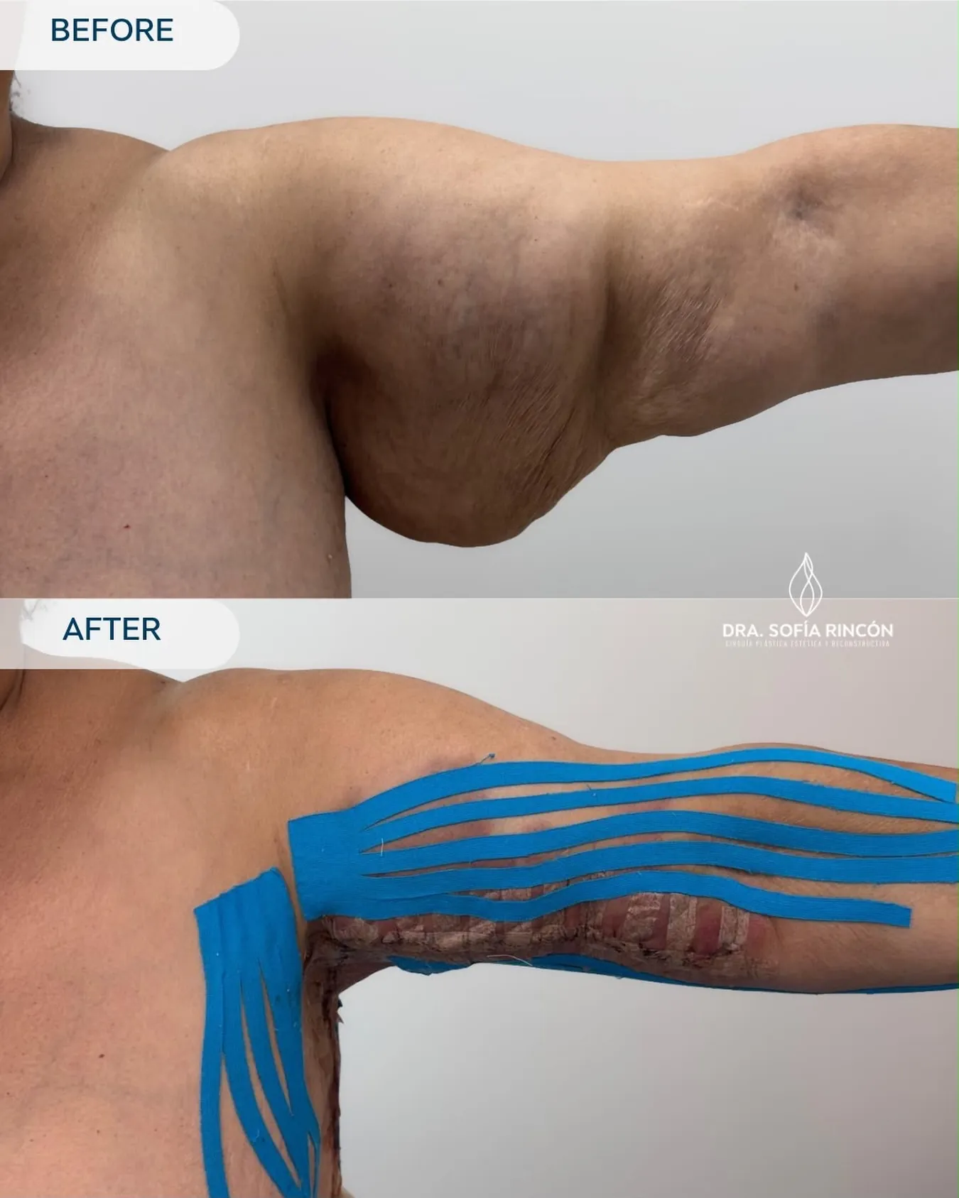 Resultado de braquioplastia antes y después 10