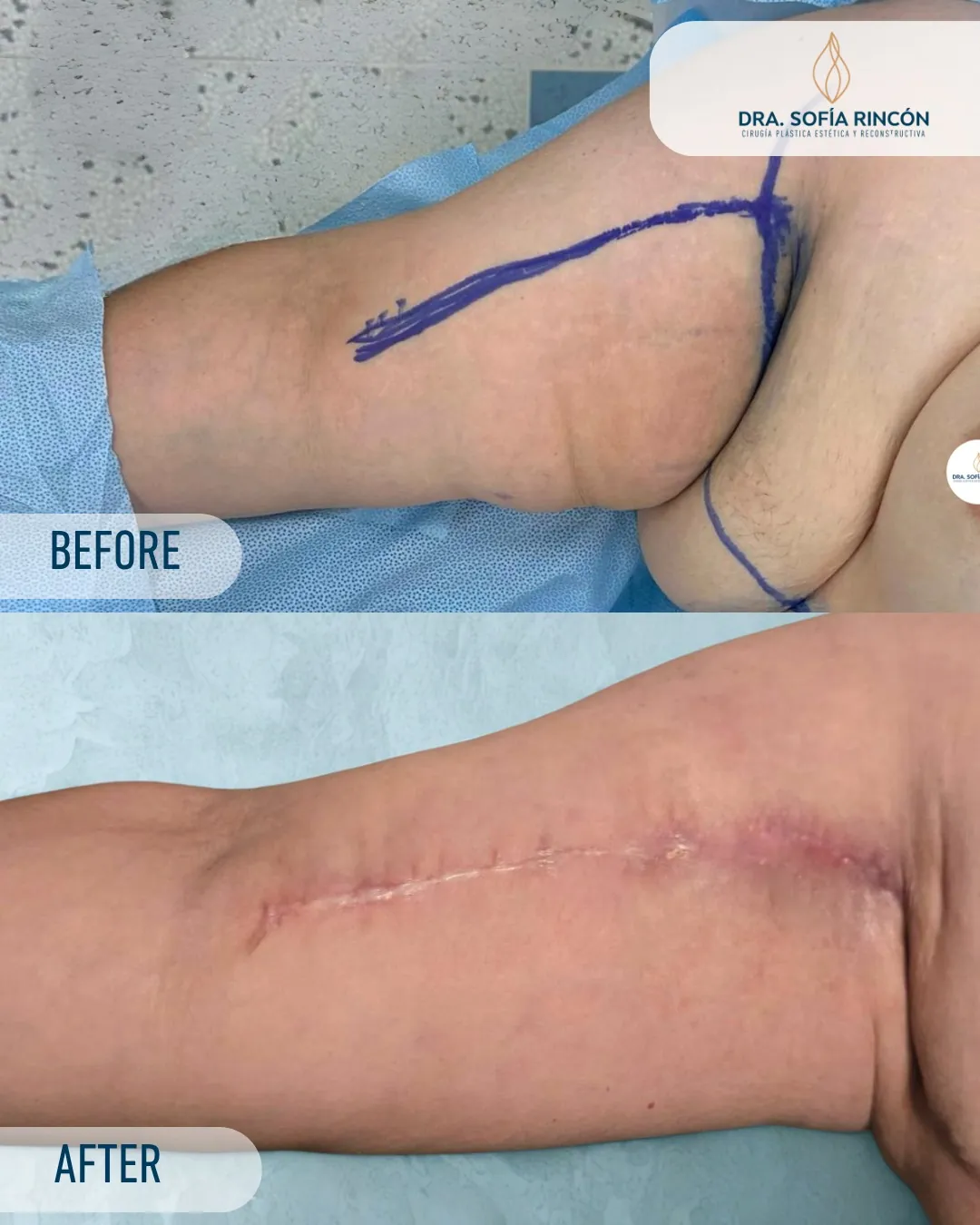 Resultado de braquioplastia antes y después 11