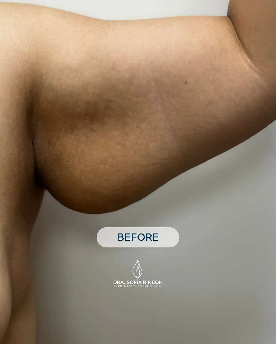 Resultado de braquioplastia antes y después 2