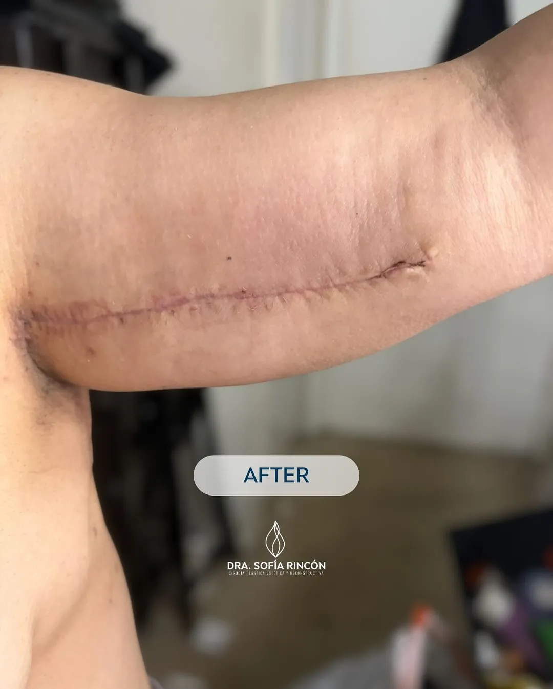 Resultado de braquioplastia antes y después 3