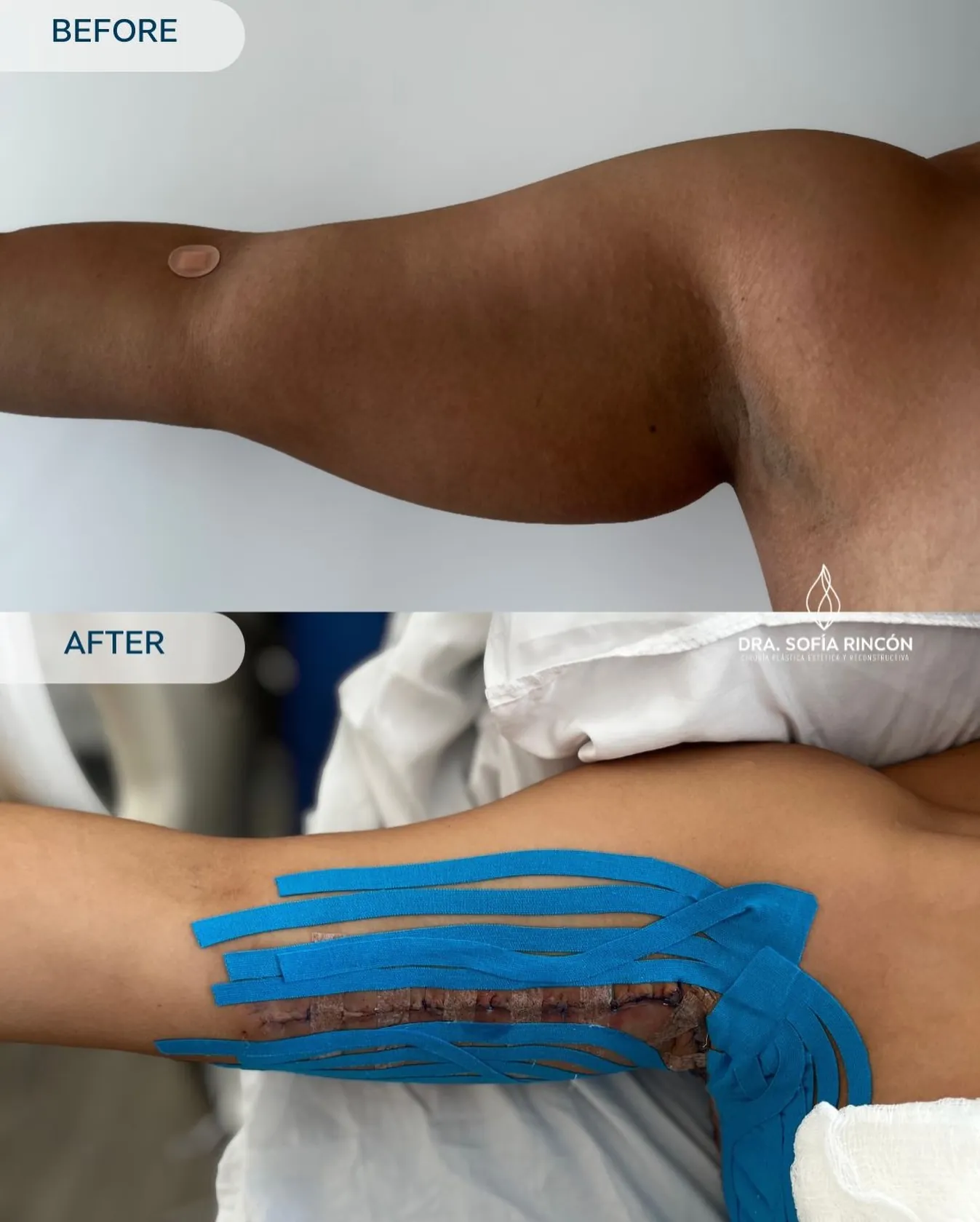 Resultado de braquioplastia antes y después 4