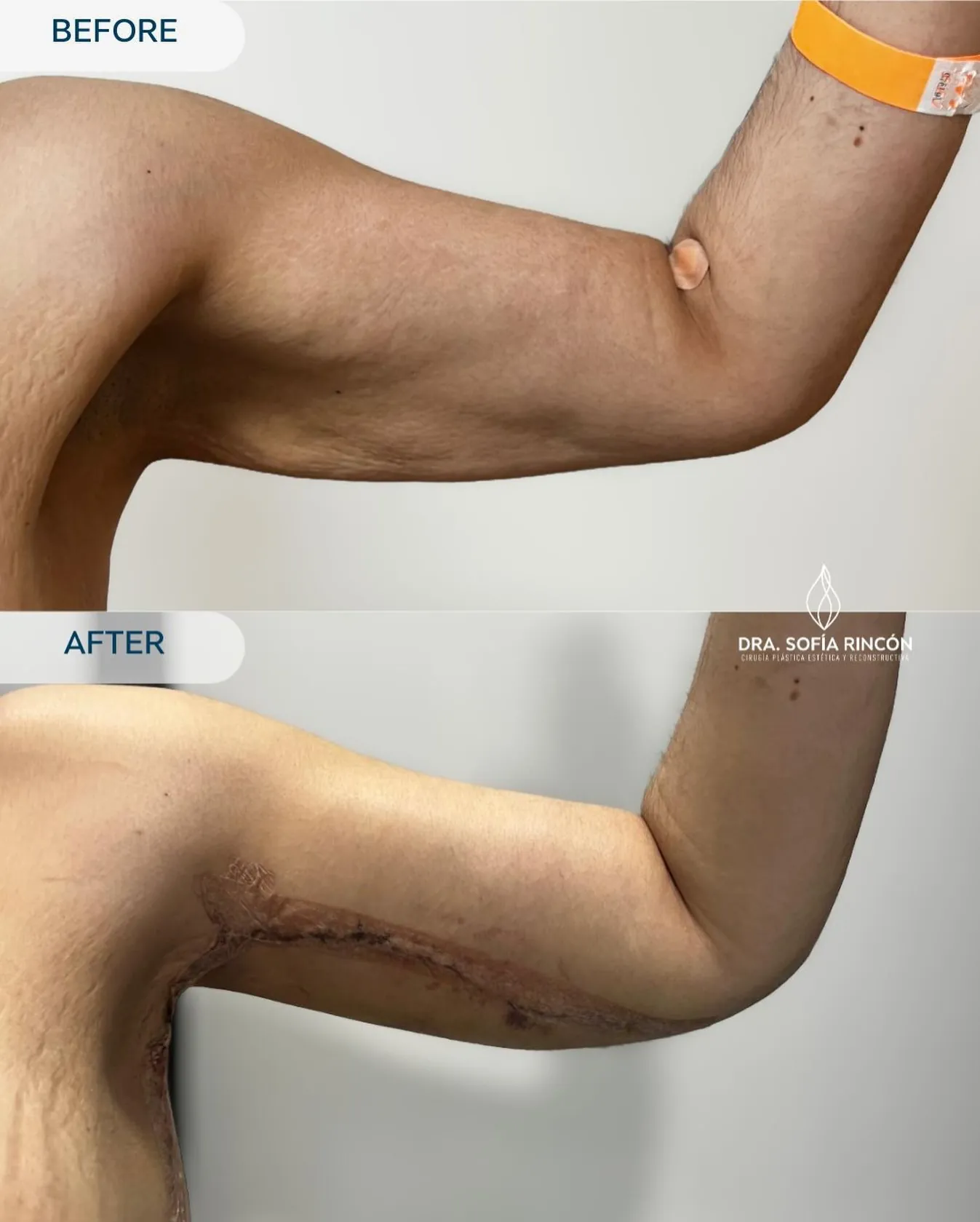 Resultado de braquioplastia antes y después 5