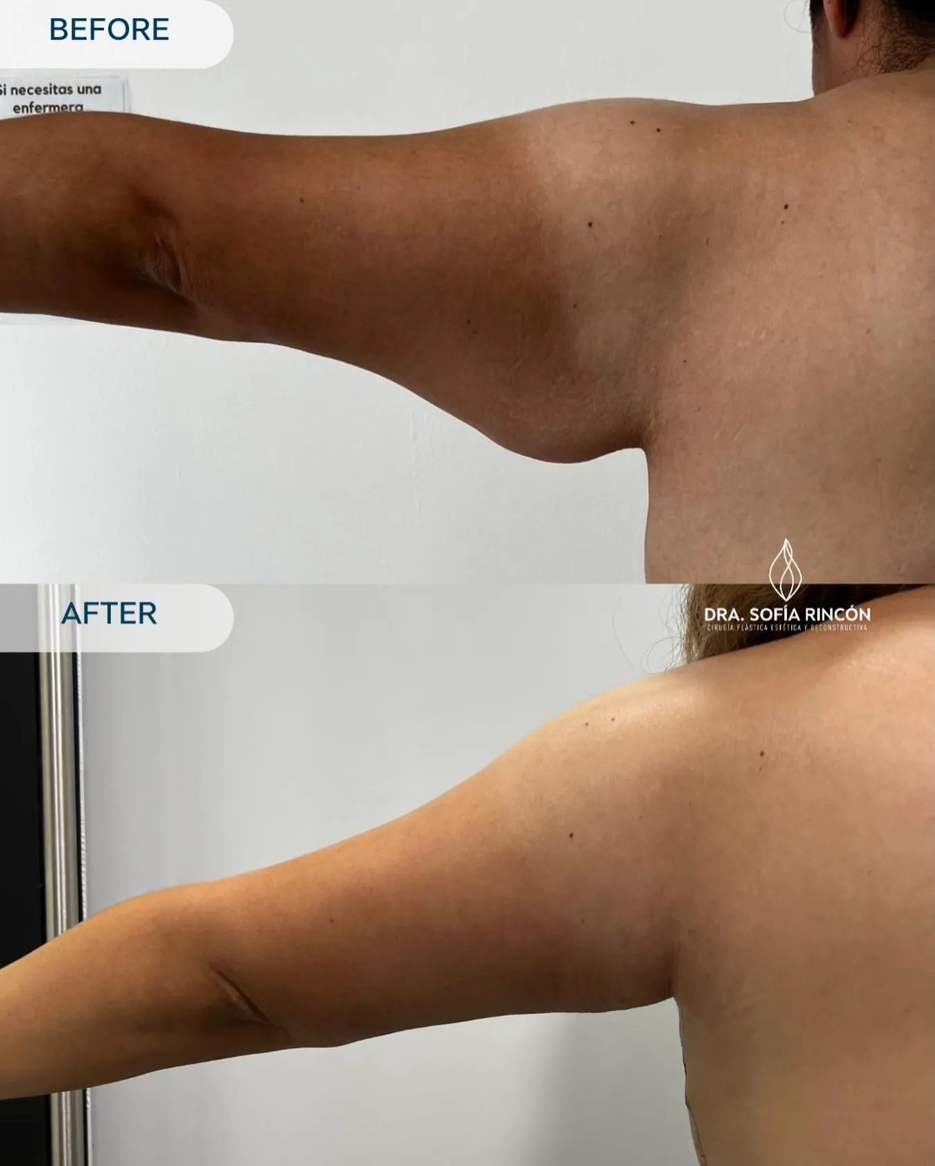 Resultado de braquioplastia antes y después 6