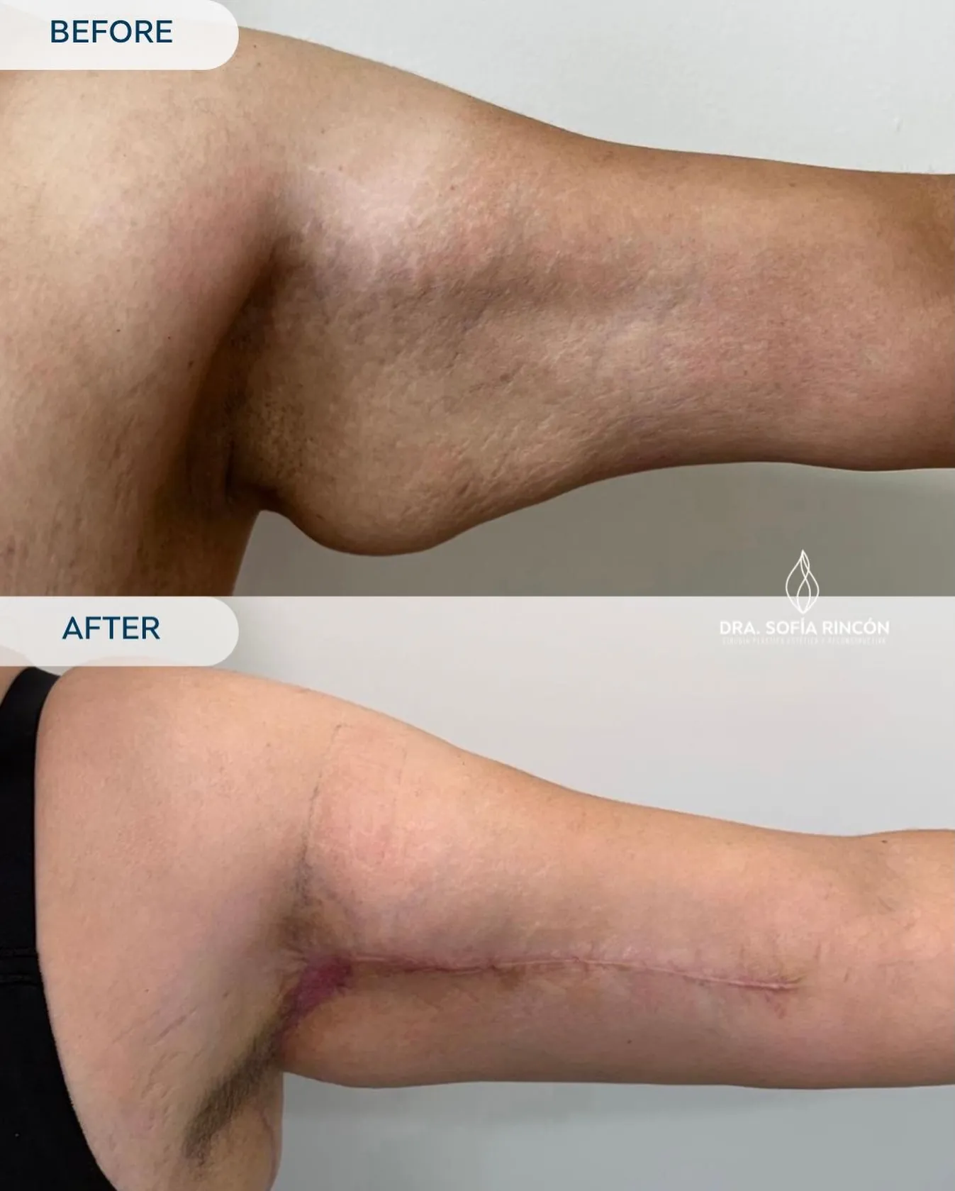 Resultado de braquioplastia antes y después 7