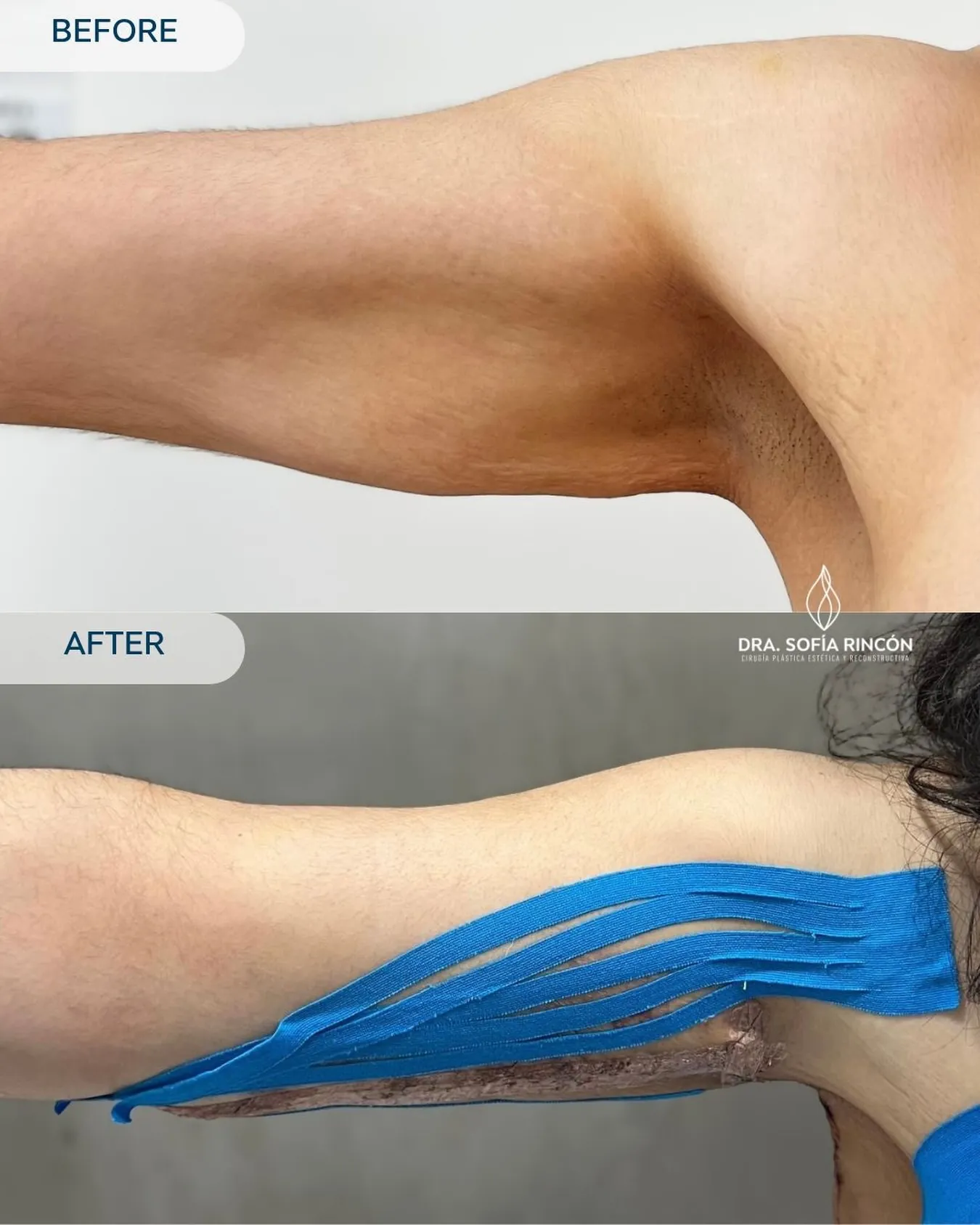 Resultado de braquioplastia antes y después 8