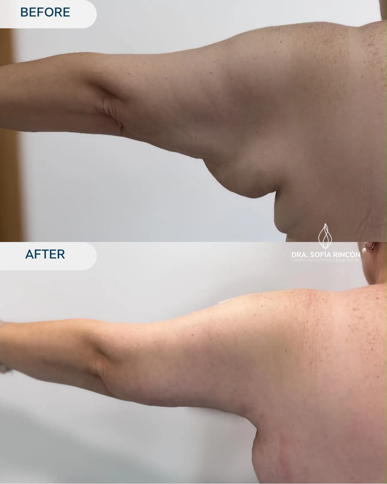 Resultado de braquioplastia antes y después 9