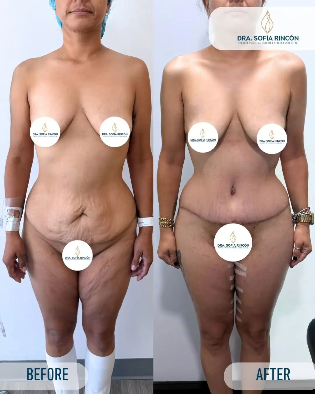 Abdominoplastia, antes y después, resultado 1
