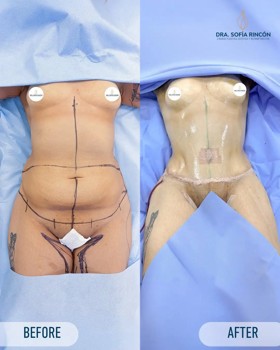 Abdominoplastia, antes y después, resultado 10