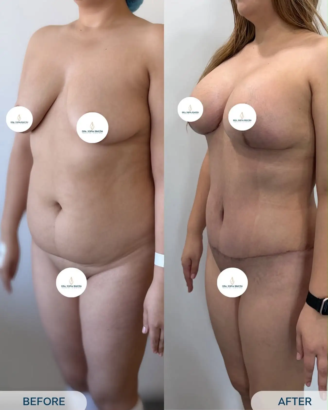 Abdominoplastia, antes y después, resultado 11