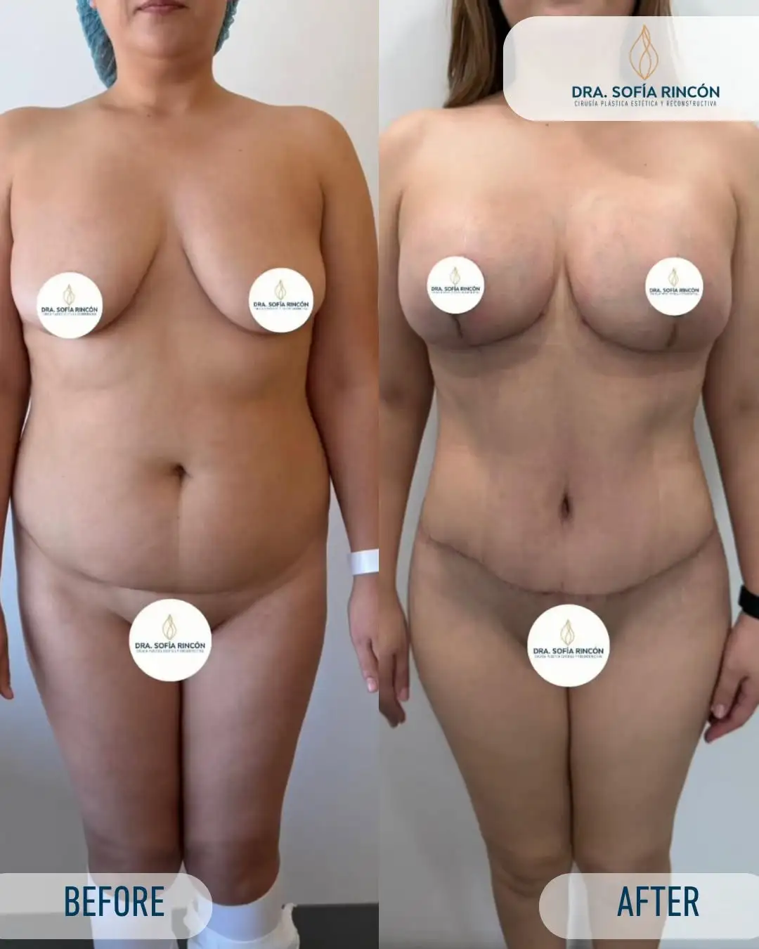 Abdominoplastia, antes y después, resultado 2