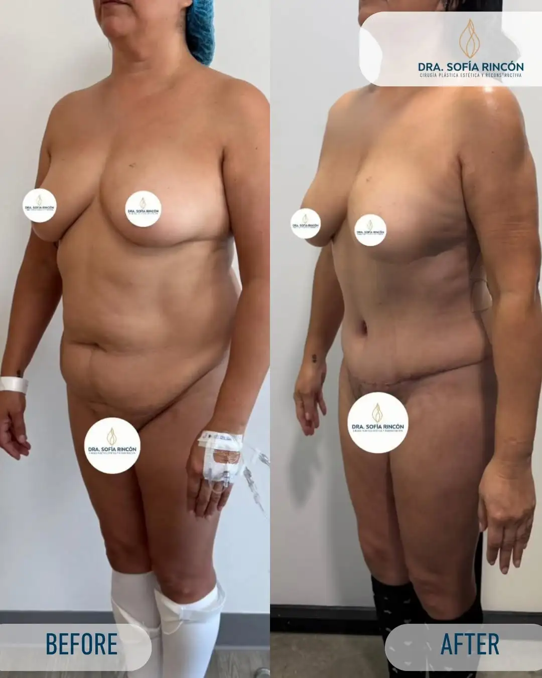 Abdominoplastia, antes y después, resultado 3