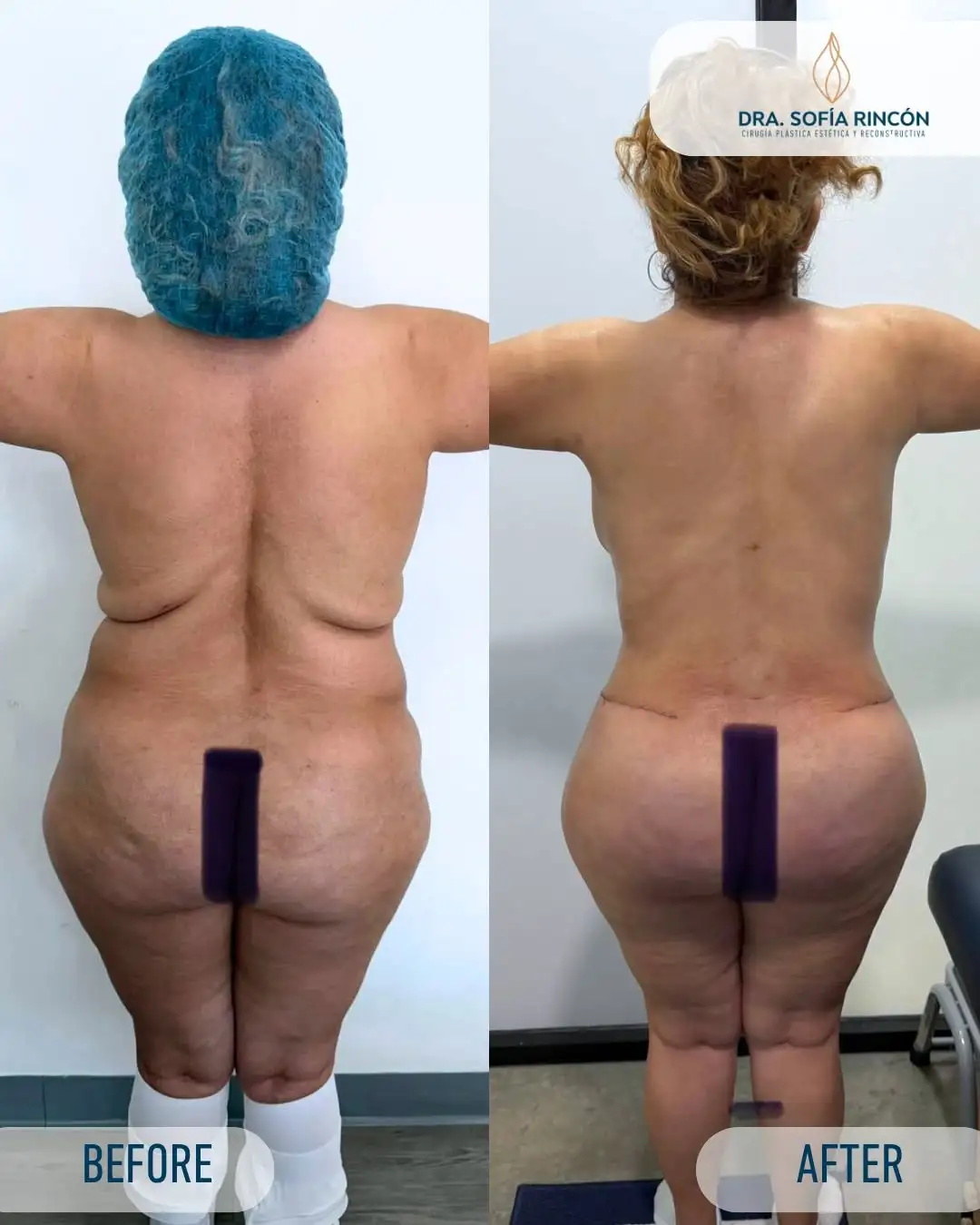 Abdominoplastia, antes y después, resultado 4