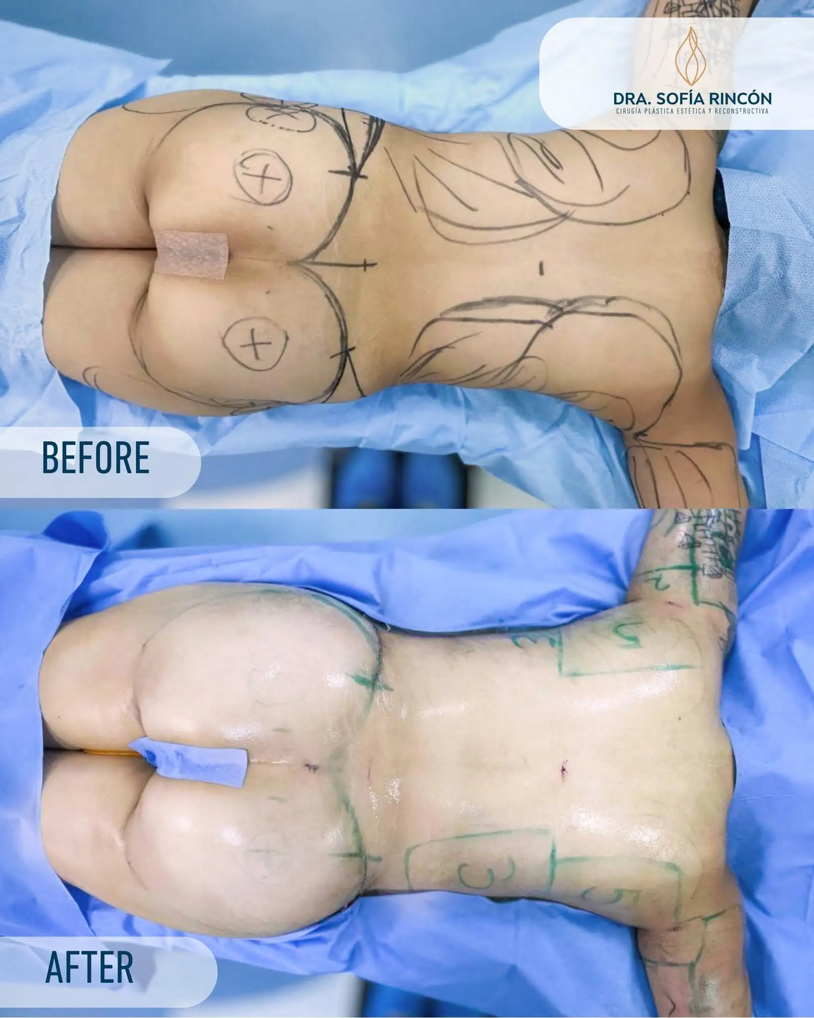 Abdominoplastia, antes y después, resultado 5
