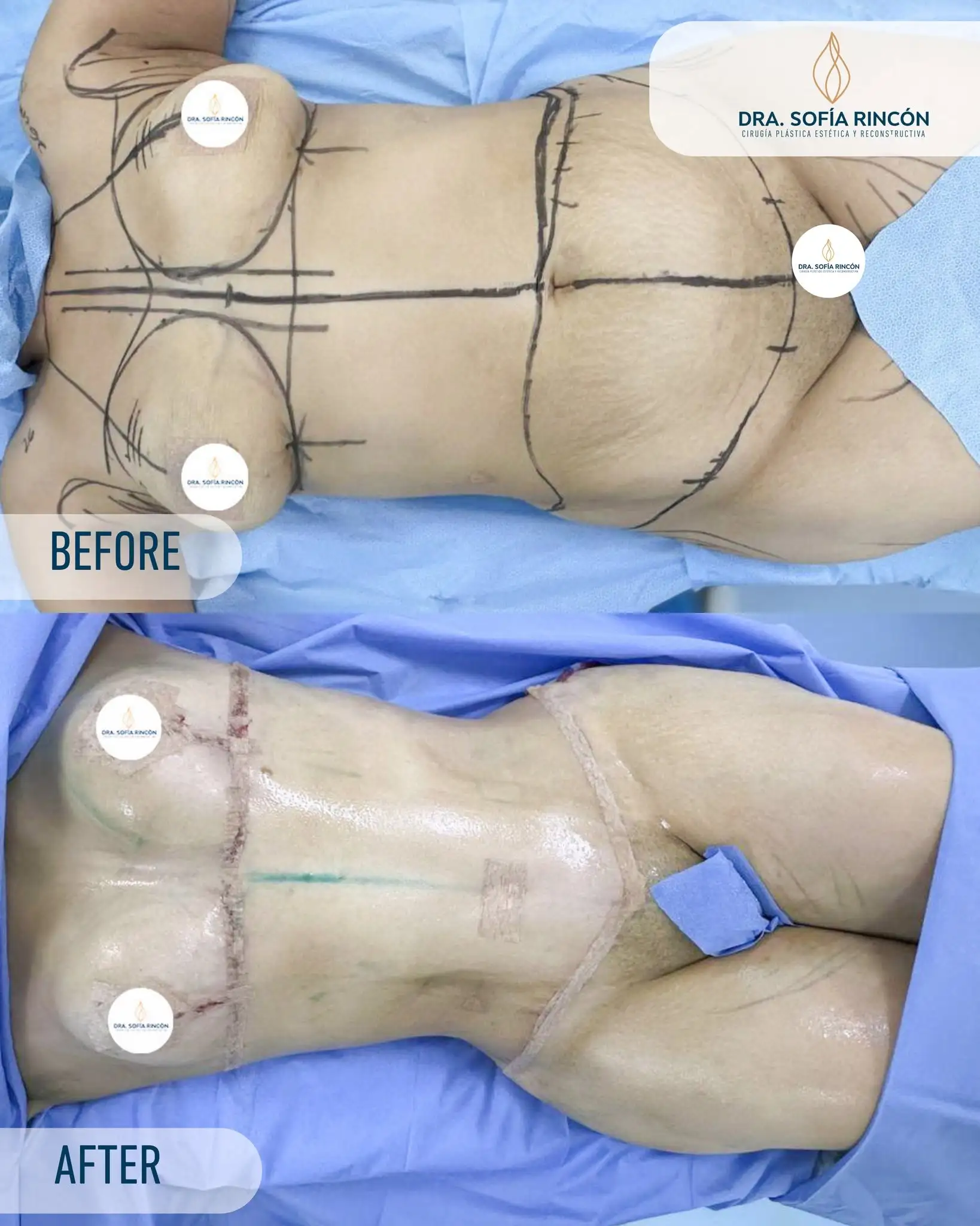 Abdominoplastia, antes y después, resultado 6