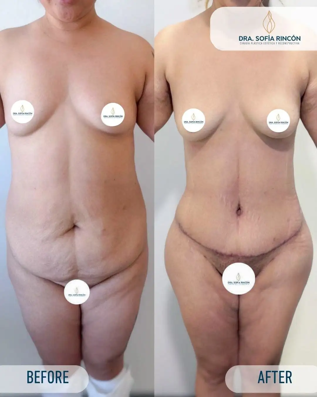 Abdominoplastia, antes y después, resultado 7