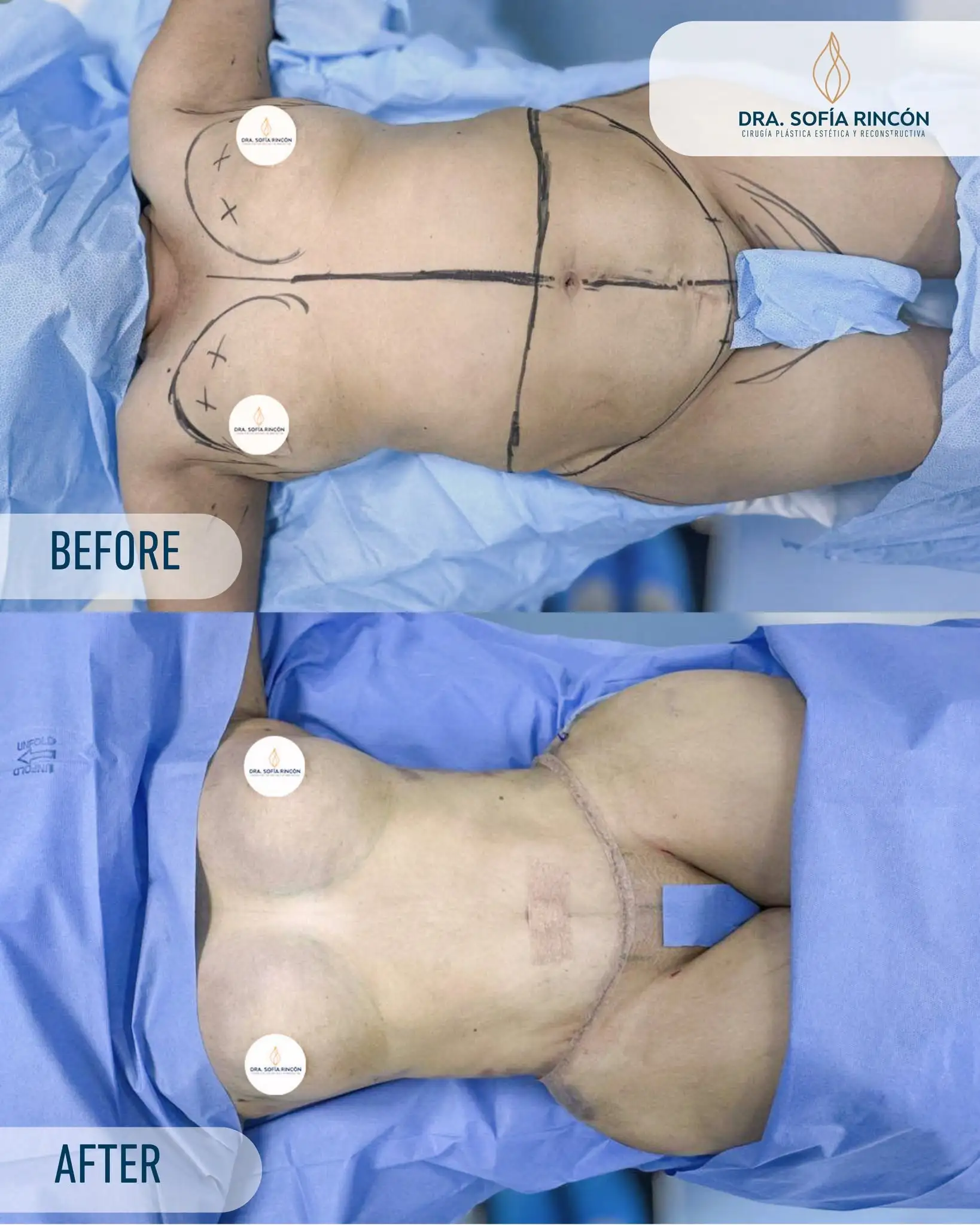 Abdominoplastia, antes y después, resultado 8