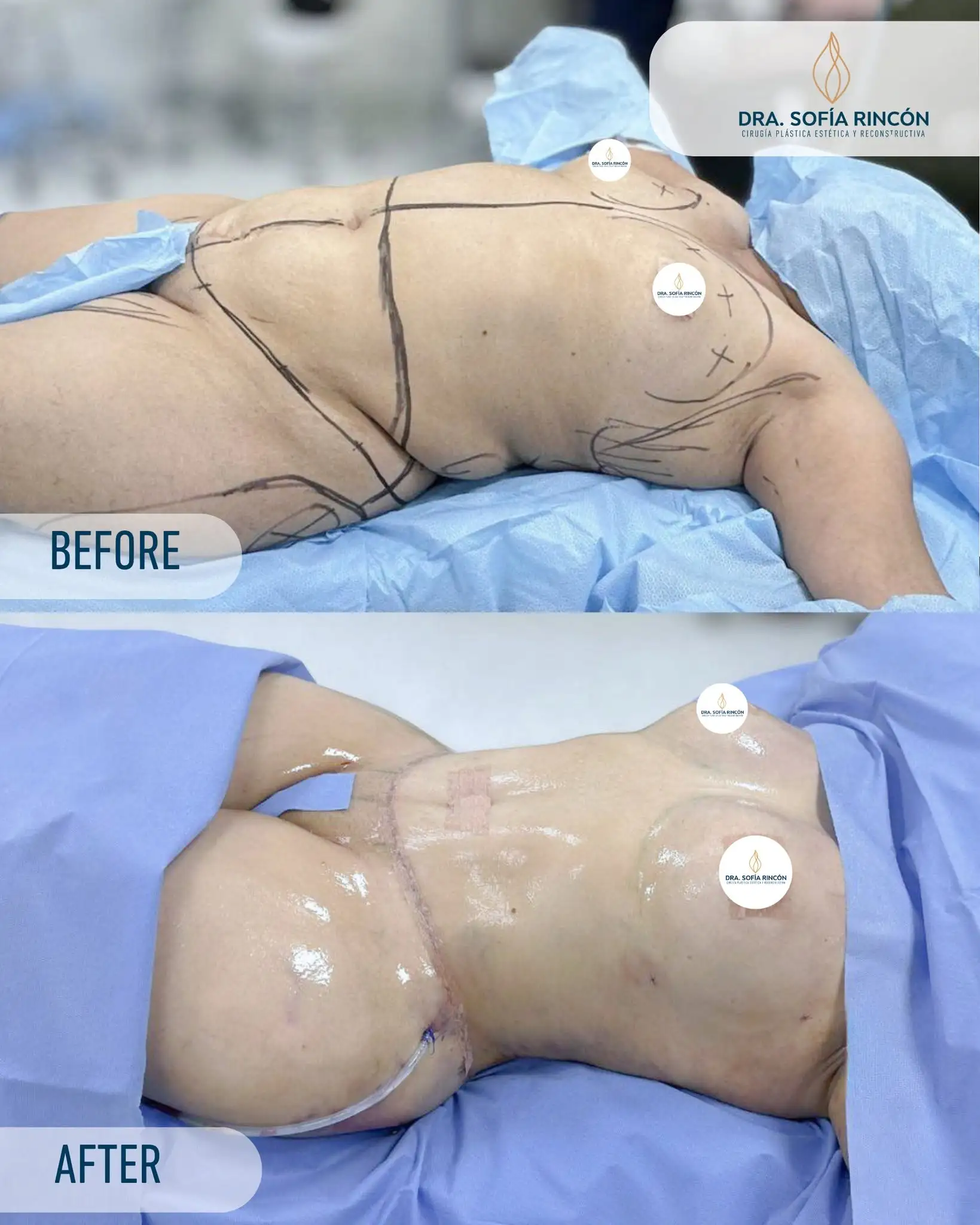 Abdominoplastia, antes y después, resultado 9